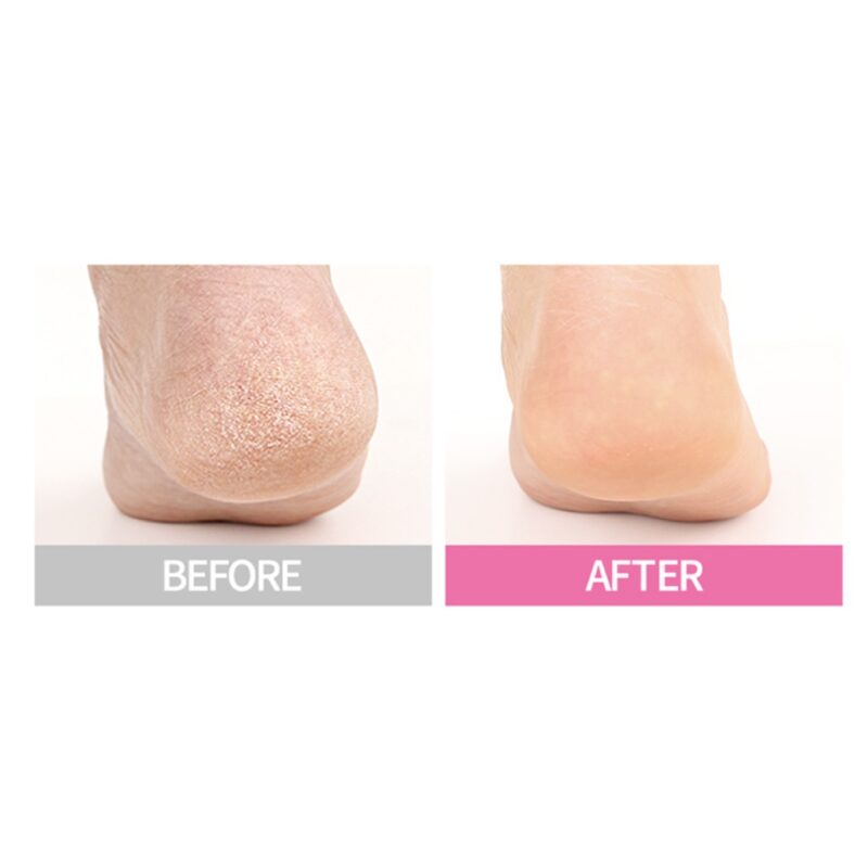 [purederm] instant softening heel mask 5 pack - moisturize and soften your dry heels with our heel mask - image 3